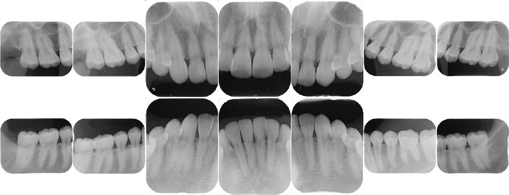 東住吉区南田辺・医療法人弘歯会 大森歯科・矯正歯科 Maintenance Clinic・X線デジタル写真(10枚法+咬翼法4枚)